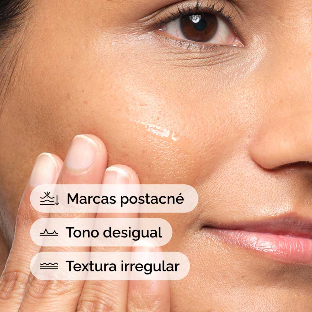ALOE 2% + NAG SOLUTION  (SUERO PARA TRATAMIENTOS POST ACN&Eacute; CON ALOE)
